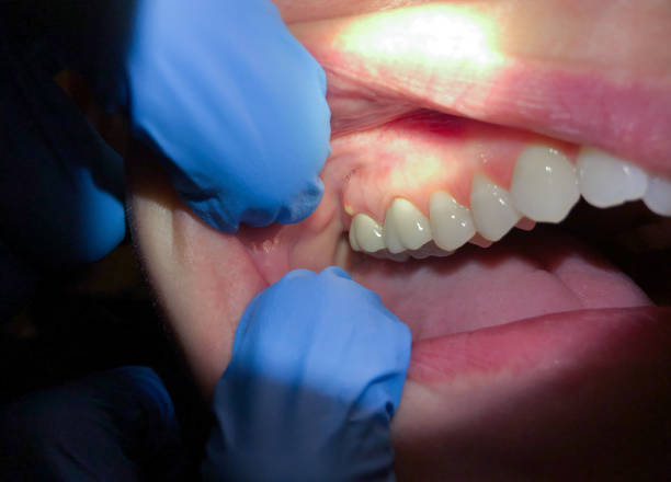 Best Same-Day Emergency Dental Services in Vernon, AL